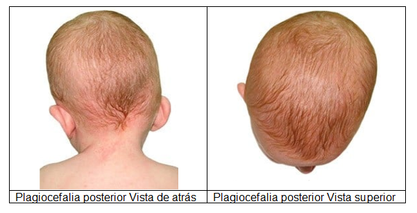 Plagiocefalia posterior
