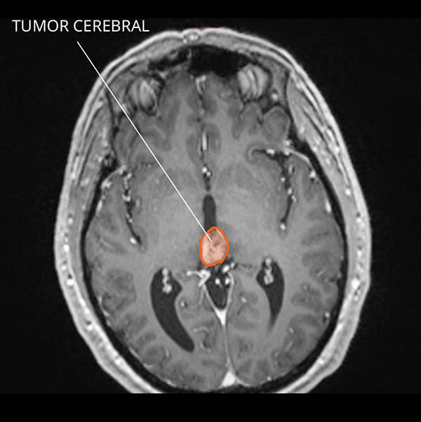 Diagnóstico Pineoblastoma