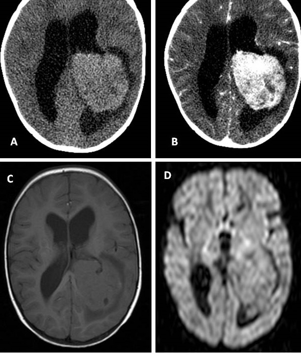 Carcinoma de plexo coroideo 